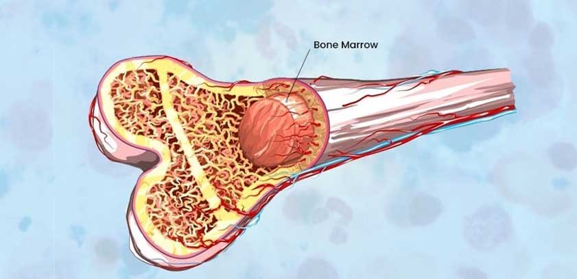 bone marrow transplantation risk