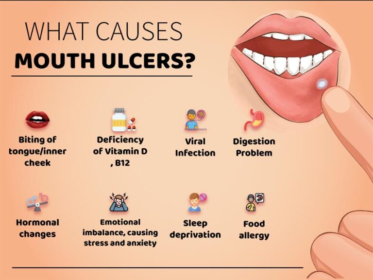 Best Medicine For Mouth Ulcer In India Planmymedical 4627