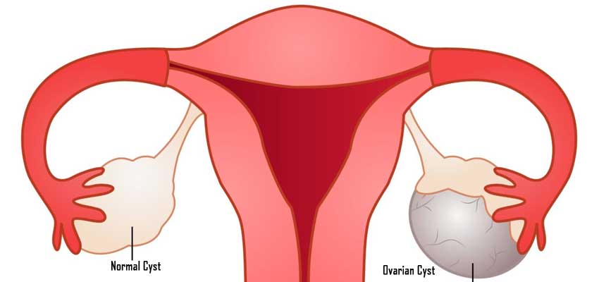 normal and ovarian cyst