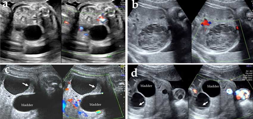 ovarian cyst treatment