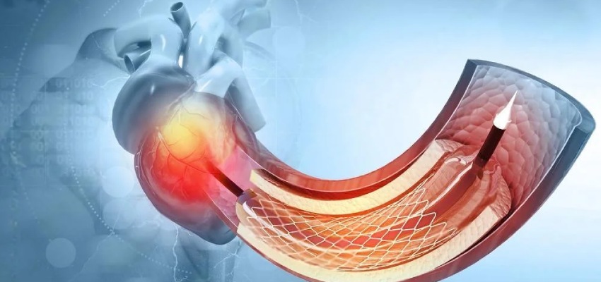 Side-Effects-due-to-Angioplasty-and-angiography