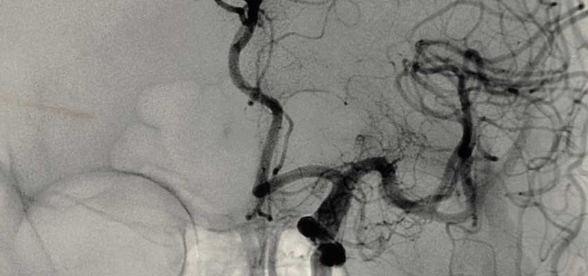 angiography procedure