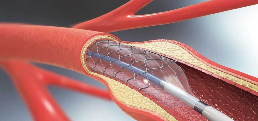 angioplasty procedure