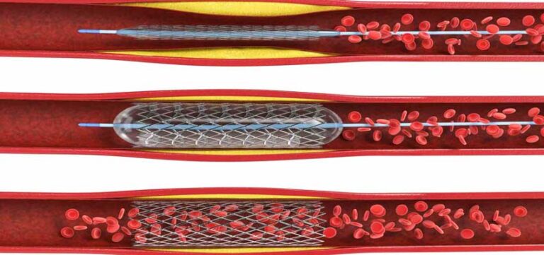 Angiography Vs Angiogram Vs Angioplasty. Know all about it. - PlanMyMedical