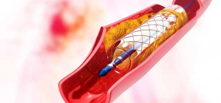 Angiography Vs Angiogram Vs Angioplasty. Know all about it. - PlanMyMedical