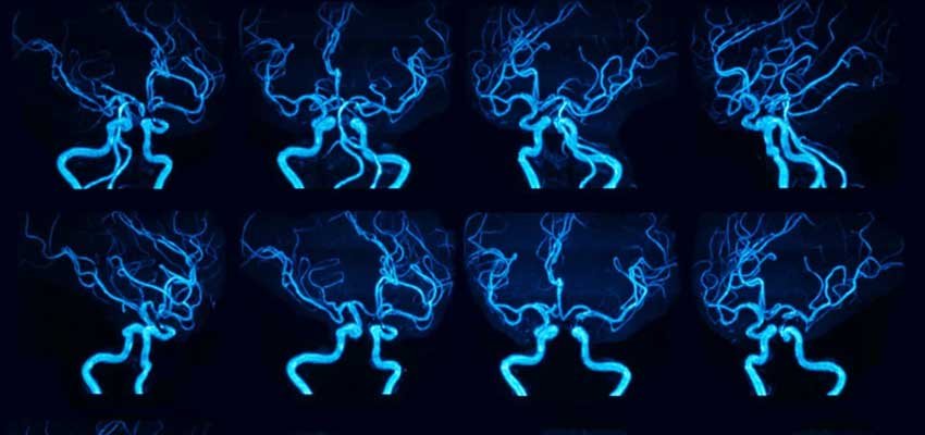 types of angiograms and procedure