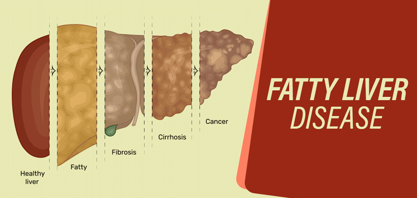 fatty liver disease