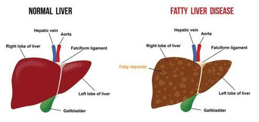 normal liver vs fatty liver