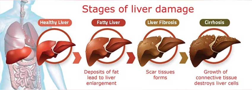 stages of liver damage