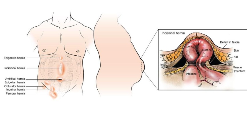 हर्निया-के-प्रकार