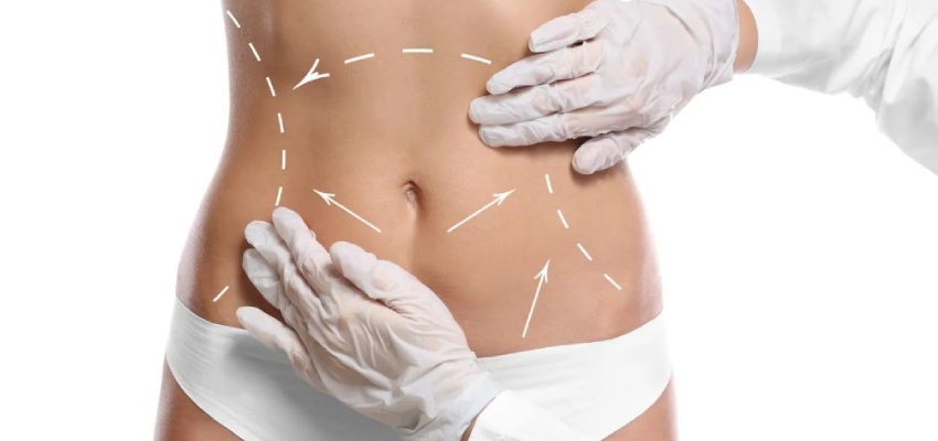 Liposuction Surgery Introduction