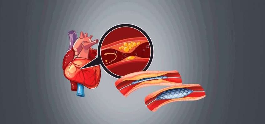 types of Angioplasty