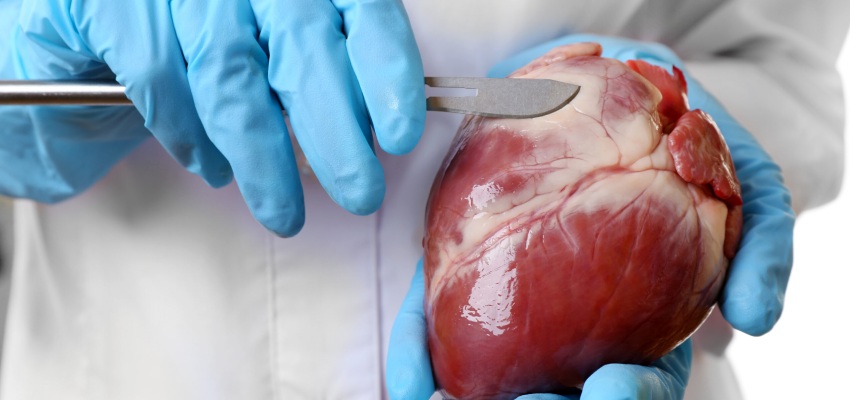 About Heart Transplant