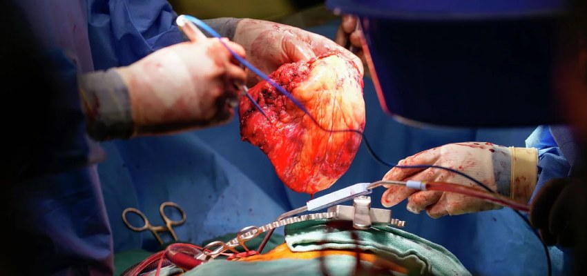 Prognosis of heart transplant