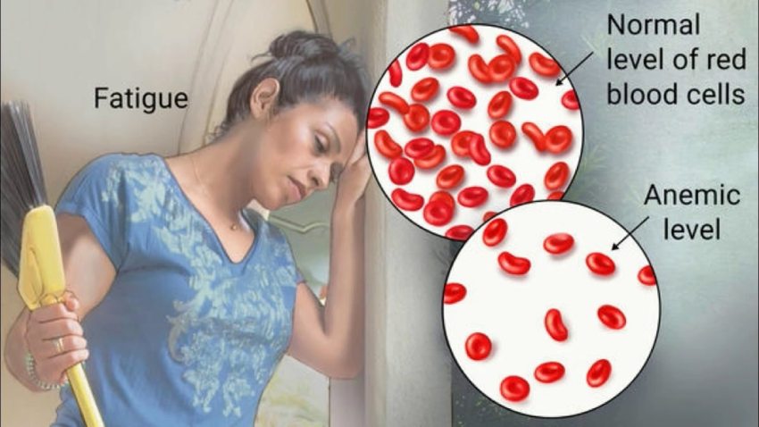 Side effects of Aplstic Anemia