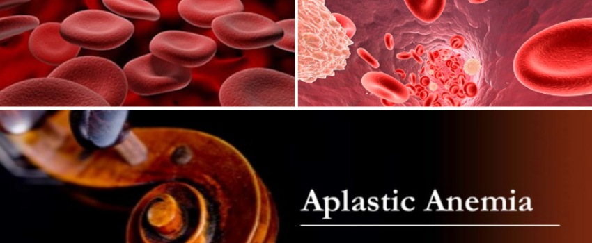 Tyeps of aplstic anemia