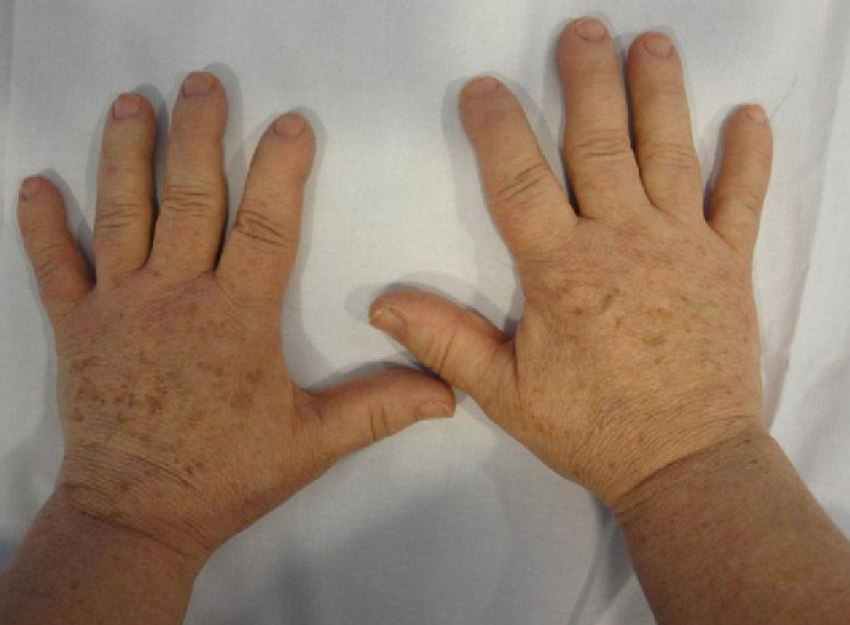 Types of Acromegaly