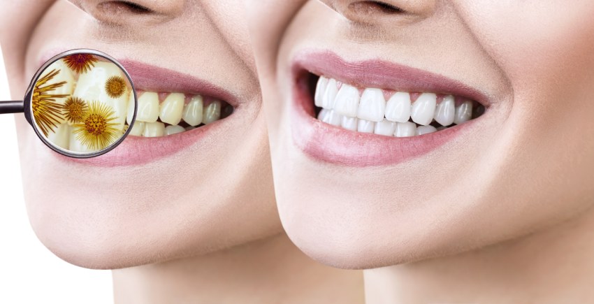 Types of teeth whitening treatment