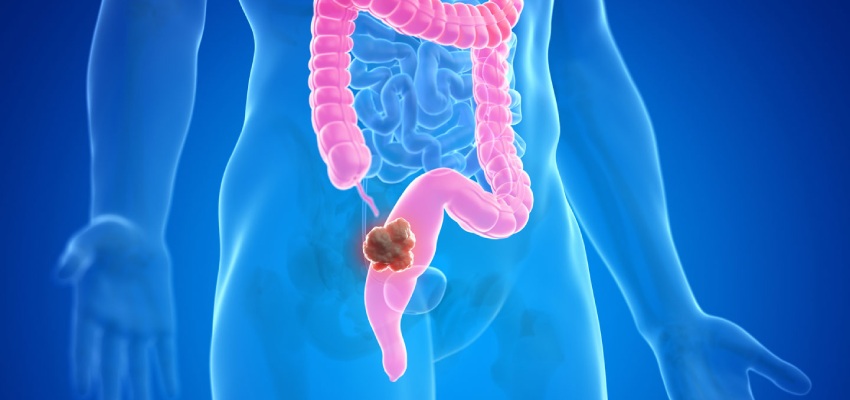 About Colorectal Cancer