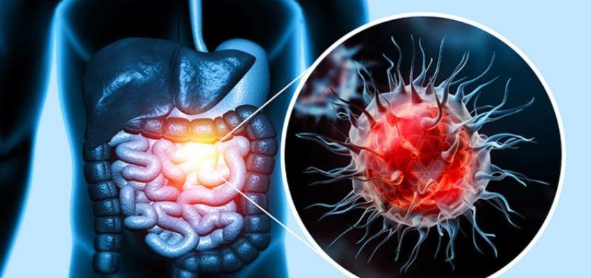 Colorectal cancer types