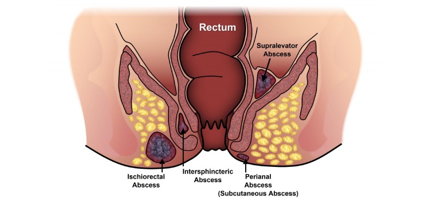 Complications of Perianal Abscess