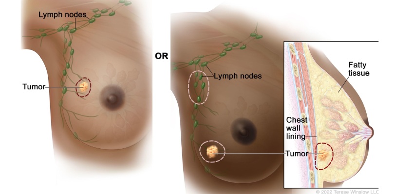 Introduction Breast Cancer Treatment