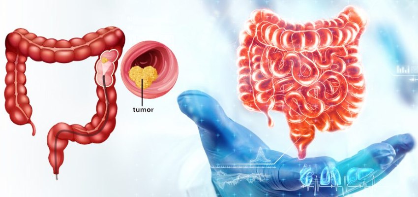 Introduction Colorectal Cancer