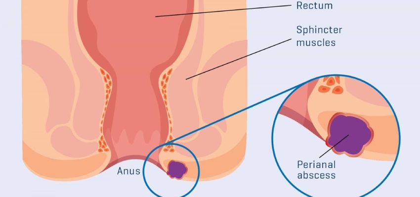 Introduction Perianal Abscess Treatment