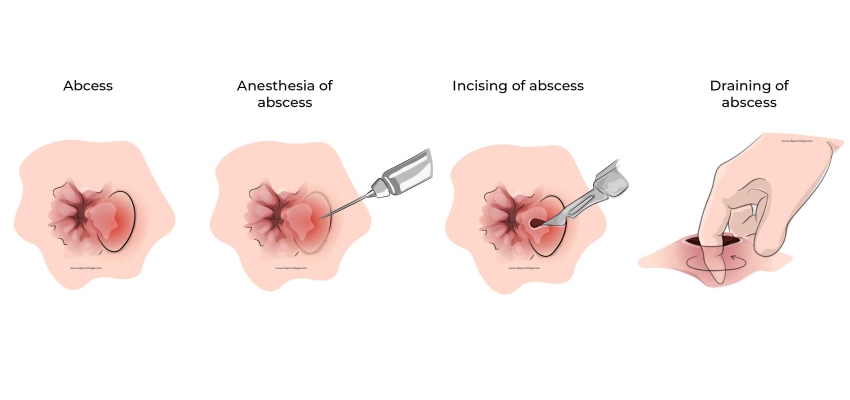 Treatment of Perianal Abscess