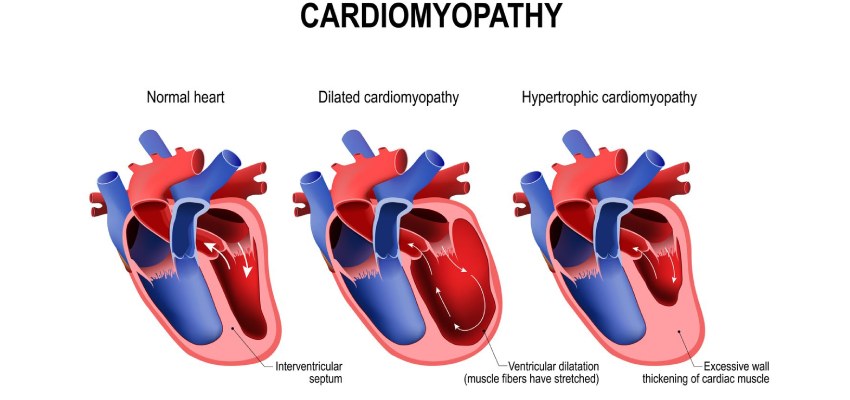 Types of Cardiomyopathy