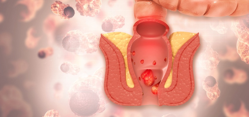 Types of Perianal Abscess