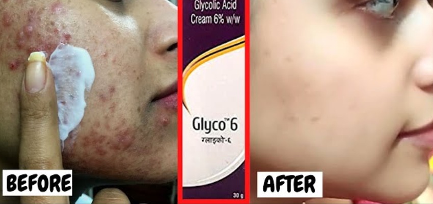 Uses Glyco 6 Cream