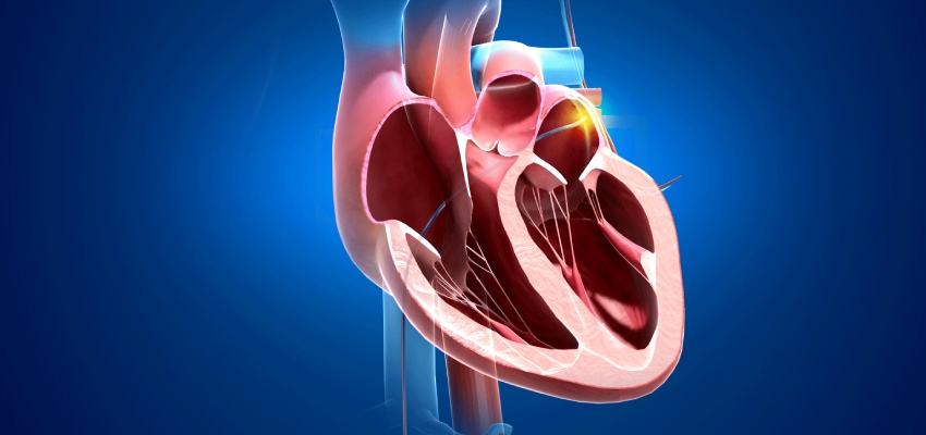 Introduction Cardiac Ablation