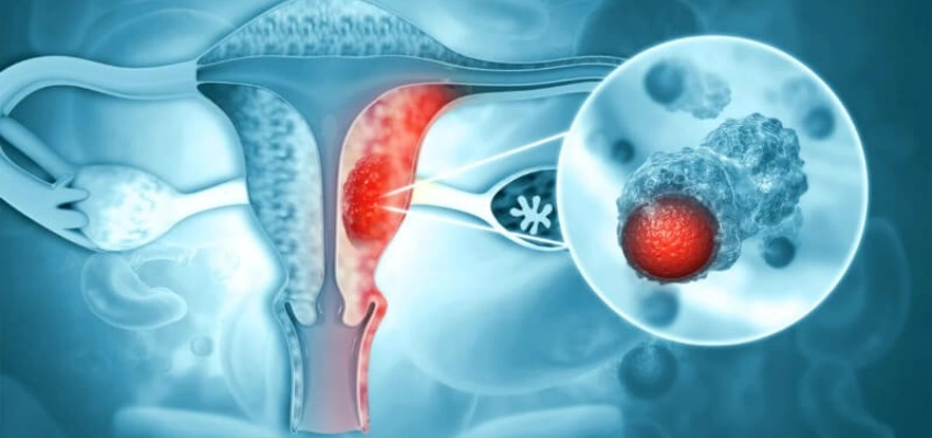 Introduction-Endometrial-Cancer-Treatment