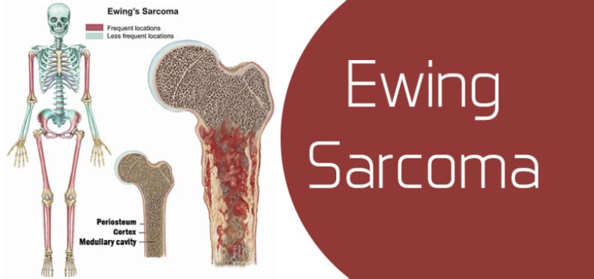 Introduction Ewing Sarcoma Treatment