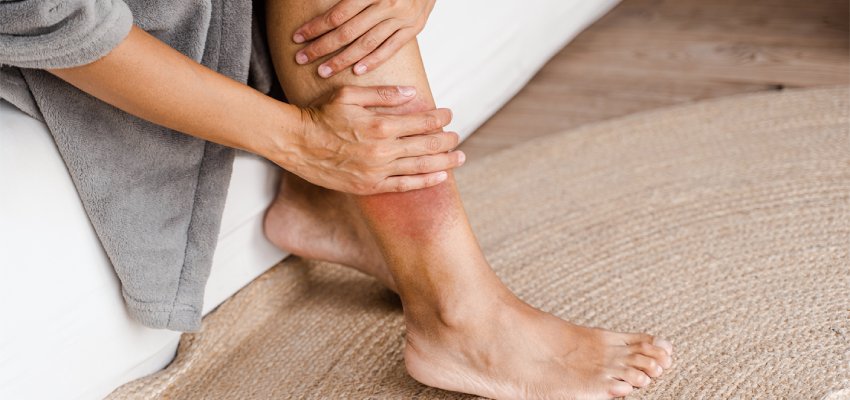 Risk factors of Deep Vein Thrombosis