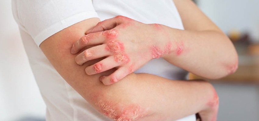 Understanding-Fungal-Infections