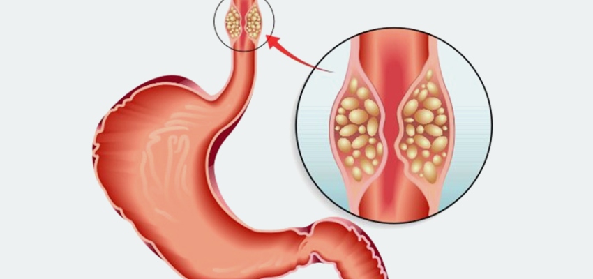 Introduction-Esophagus-Cancer-Treatment