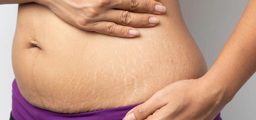 Side-effects-of-stretch-marks-creams