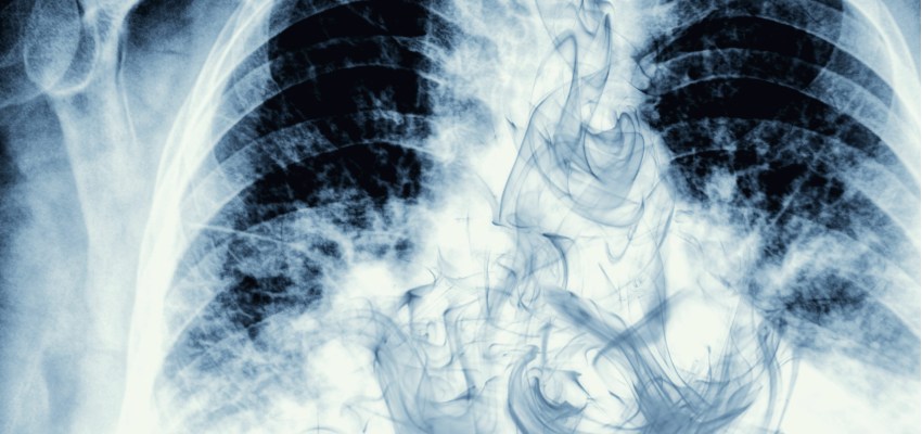 Smoker’s-Lung-X-ray