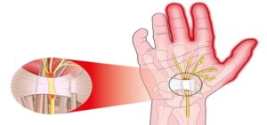 कार्पल टनल सिंड्रोम के कारण क्या है