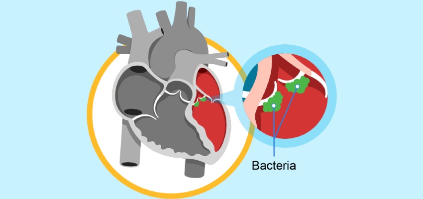 Introduction Endocarditis Treatment