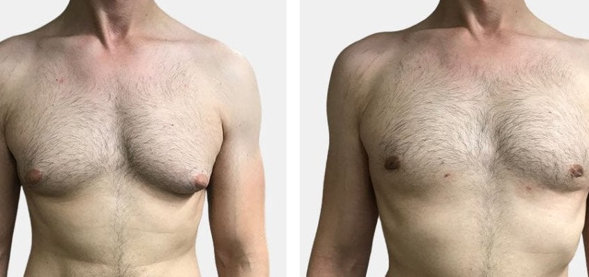 Understanding Gynecomastia