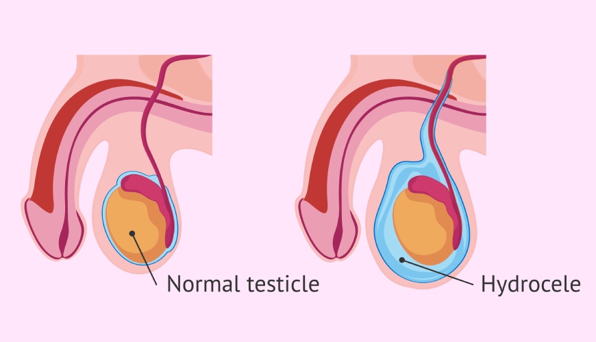 Different Symptoms of hydrocele