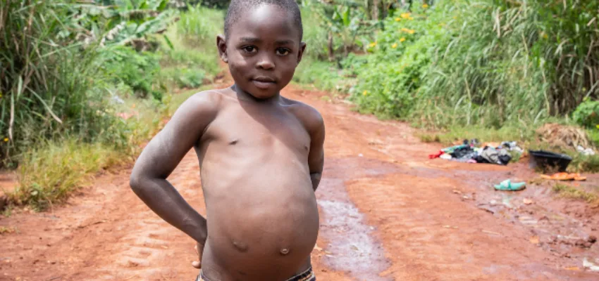 Causes of kwashiorkor