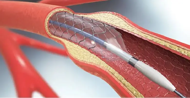 Angioplasty Introduction