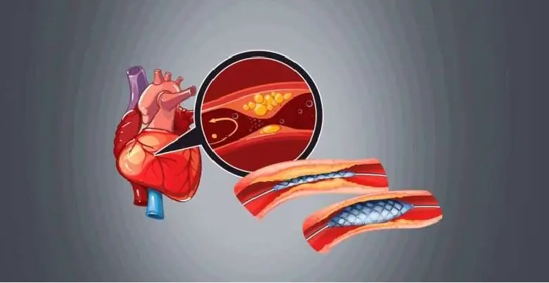 types of Angioplasty