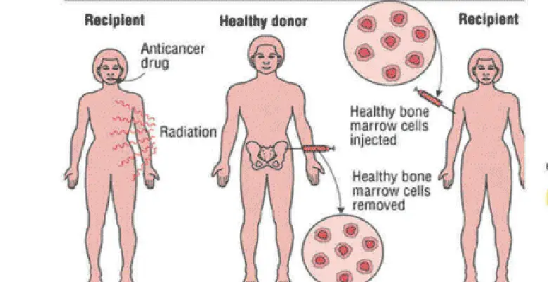 bone marrow transplant procedure in india