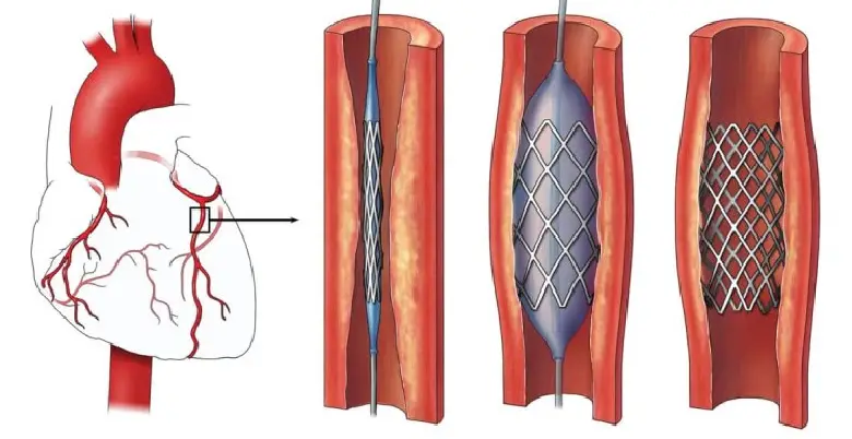 Concerns Before to and After Surgery