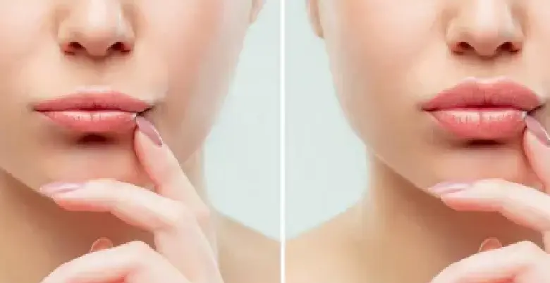 lip reduction surgery best doctors